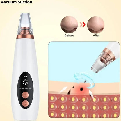 BLACKHEADS REMOVER