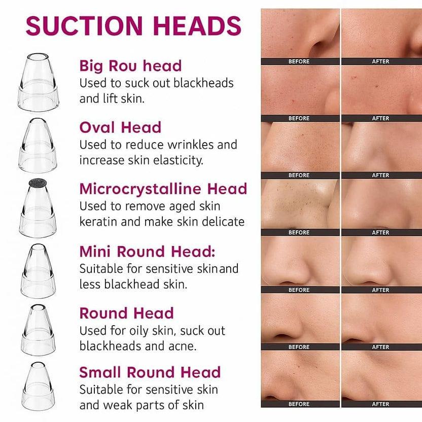 BLACKHEADS REMOVER