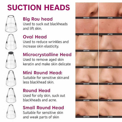 BLACKHEADS REMOVER