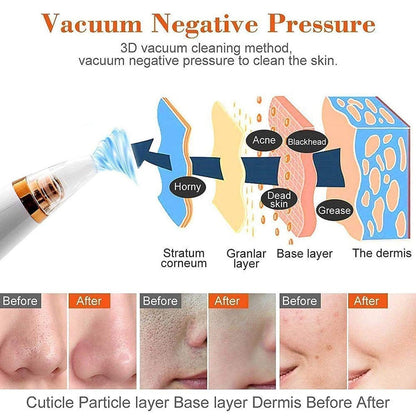 BLACKHEADS REMOVER